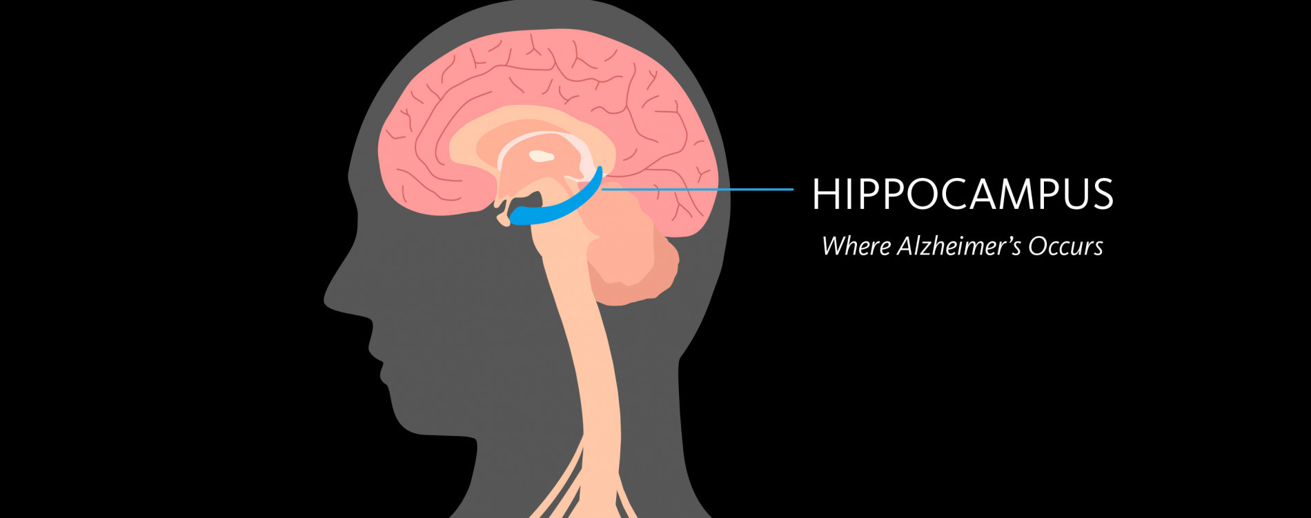 Diagram showing the brain areas commonly affected by dementia